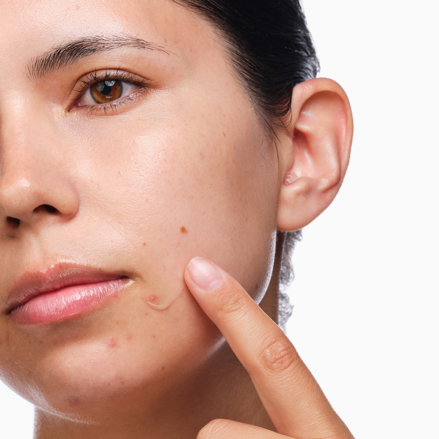 Three-Step Acne Skincare Set