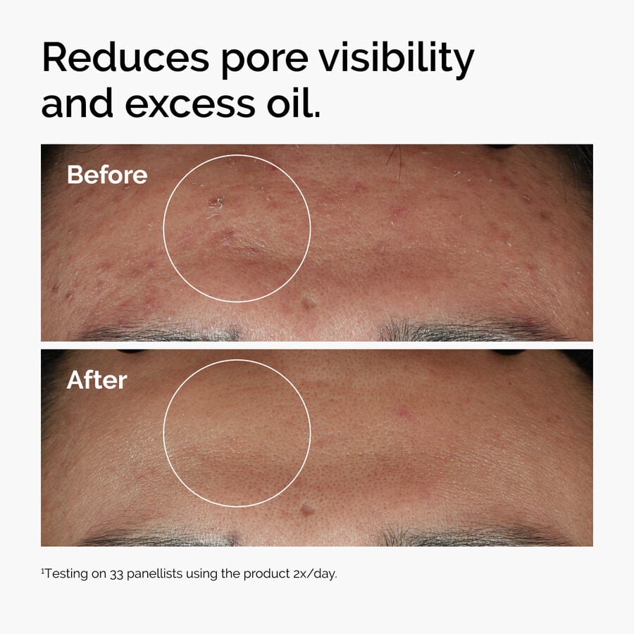 Niacinamide 10% + Zinc 1% Blemish-Support Serum