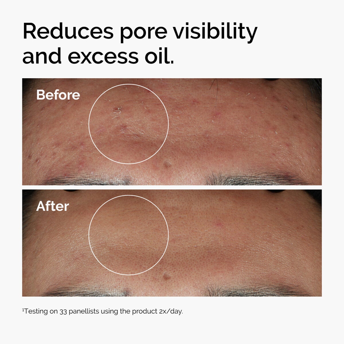 Niacinamide 10% + Zinc 1% Blemish-Support Serum